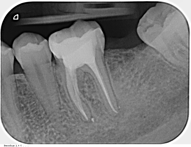 Zhojenie nálezu po 5 mesiacoch. MDDr. Gaľa